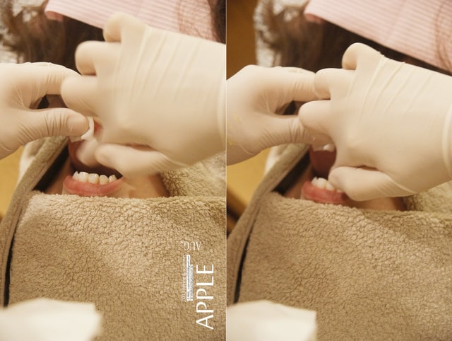 【美保】日亞美牙齒美白&美唇護理。平價優質的日系牙科診所❤