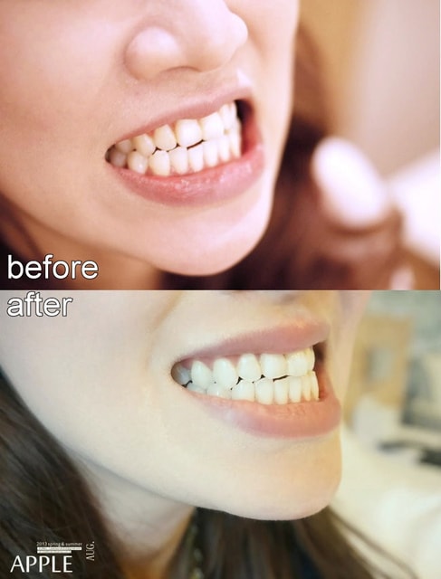 【美保】日亞美牙齒美白&美唇護理。平價優質的日系牙科診所❤