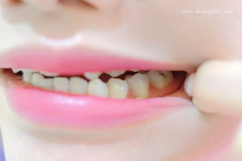 【看牙日記】我的崩牙拯救紀錄 // 台北牙醫推薦:悅庭牙醫診所/全瓷冠/3D齒雕 - 第10張圖 DSCF8919