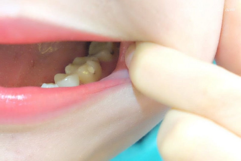 【看牙日記】我的崩牙拯救紀錄 // 台北牙醫推薦:悅庭牙醫診所/全瓷冠/3D齒雕 - 第11張圖 DSCF9690