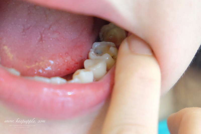 【看牙日記】我的崩牙拯救紀錄 // 台北牙醫推薦:悅庭牙醫診所/全瓷冠/3D齒雕 - 第20張圖 DSCF9771