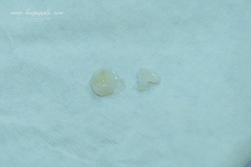 【看牙日記】我的崩牙拯救紀錄 // 台北牙醫推薦:悅庭牙醫診所/全瓷冠/3D齒雕 - 第34張圖 DSCF9933