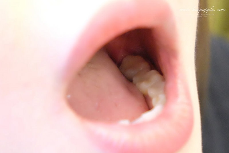 【看牙日記】我的崩牙拯救紀錄 // 台北牙醫推薦:悅庭牙醫診所/全瓷冠/3D齒雕 - 第41張圖 DSCF9990