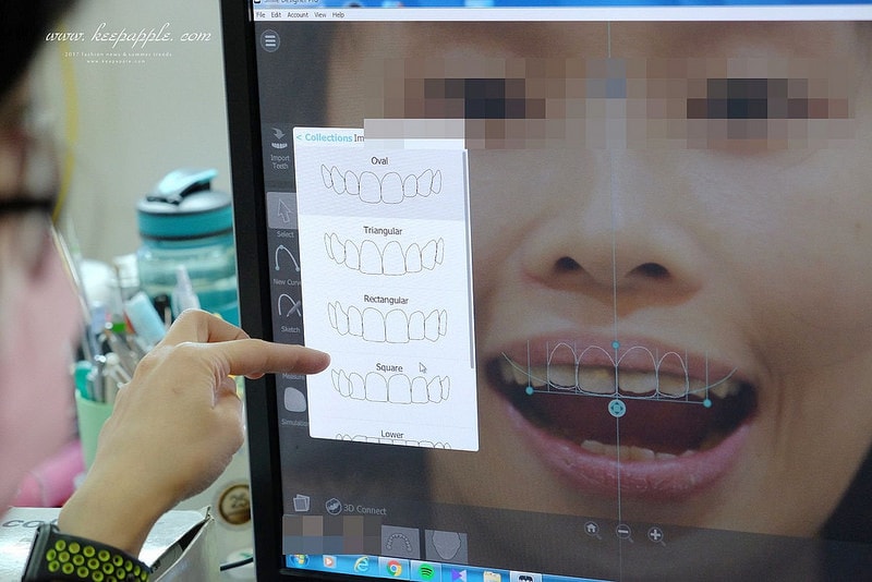 【看牙日記】我的崩牙拯救紀錄 // 台北牙醫推薦:悅庭牙醫診所/全瓷冠/3D齒雕 - 第47張圖 DSCF0018