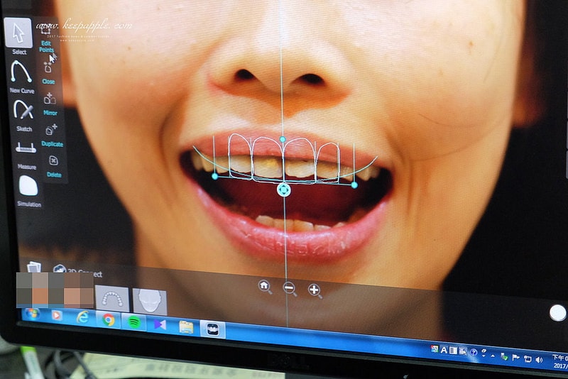 【看牙日記】我的崩牙拯救紀錄 // 台北牙醫推薦:悅庭牙醫診所/全瓷冠/3D齒雕 - 第48張圖 DSCF0020