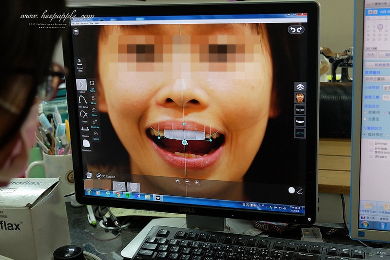 【看牙日記】我的崩牙拯救紀錄 // 台北牙醫推薦:悅庭牙醫診所/全瓷冠/3D齒雕 - 第49張圖 DSCF0022