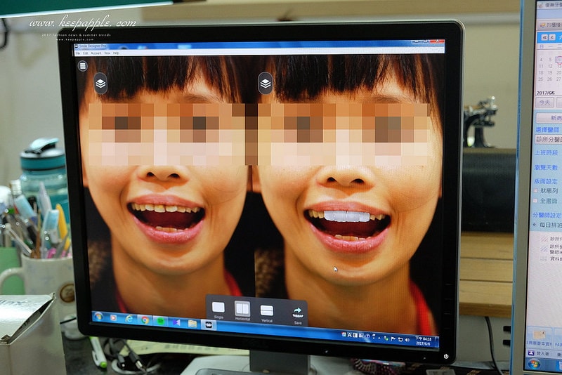 【看牙日記】我的崩牙拯救紀錄 // 台北牙醫推薦:悅庭牙醫診所/全瓷冠/3D齒雕 - 第50張圖 DSCF0028