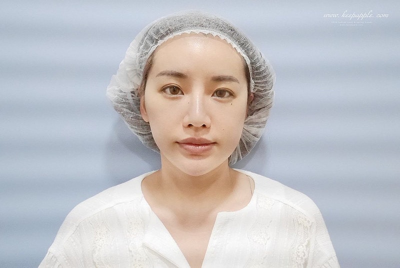 【醫美】舒顏美人幫X複合性療程。解決一直在意的臉凹問題 - 第20張圖 P1460323