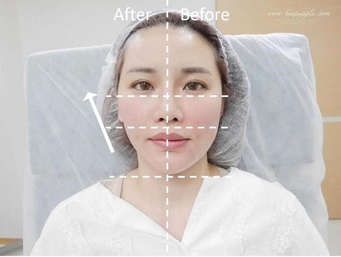 【醫美】舒顏美人幫X複合性療程。解決一直在意的臉凹問題 - 第29張圖 1