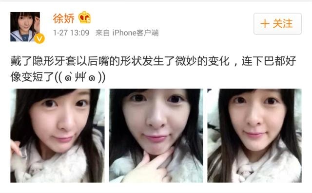 【牙套之路vol.2】隱適美跟其他牙套有什麼不一樣呢?之預備心得簡單分享 - 第5張圖 pn50003125p2rq3n26r