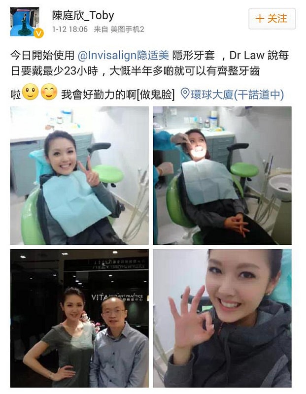 【牙套之路vol.2】隱適美跟其他牙套有什麼不一樣呢?之預備心得簡單分享 - 第6張圖 q0100024psr41rs0o21