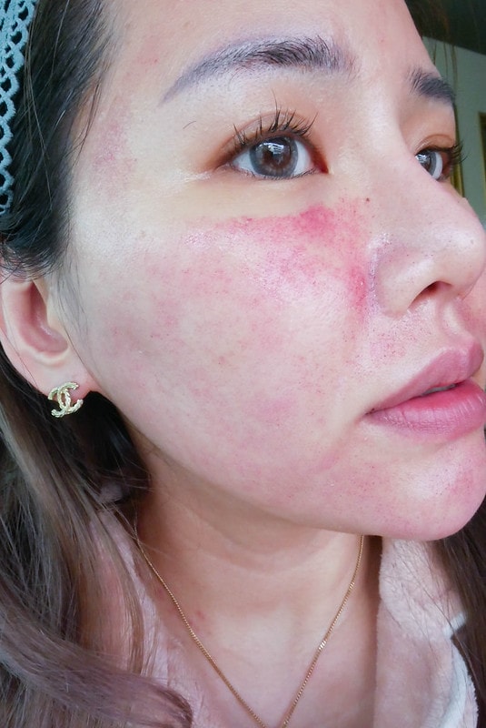 【醫美】Nice Clinic耐斯診所 。水飛梭(海菲秀)+探索皮秒一起來 給我煥然一新晶透好膚質 - 第32張圖 P1220709