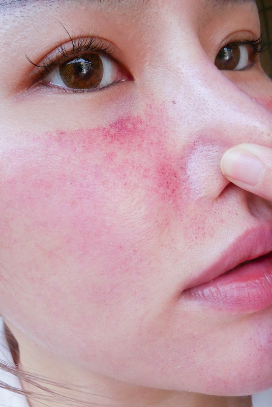 【醫美】Nice Clinic耐斯診所 。水飛梭(海菲秀)+探索皮秒一起來 給我煥然一新晶透好膚質 - 第33張圖 P1220731