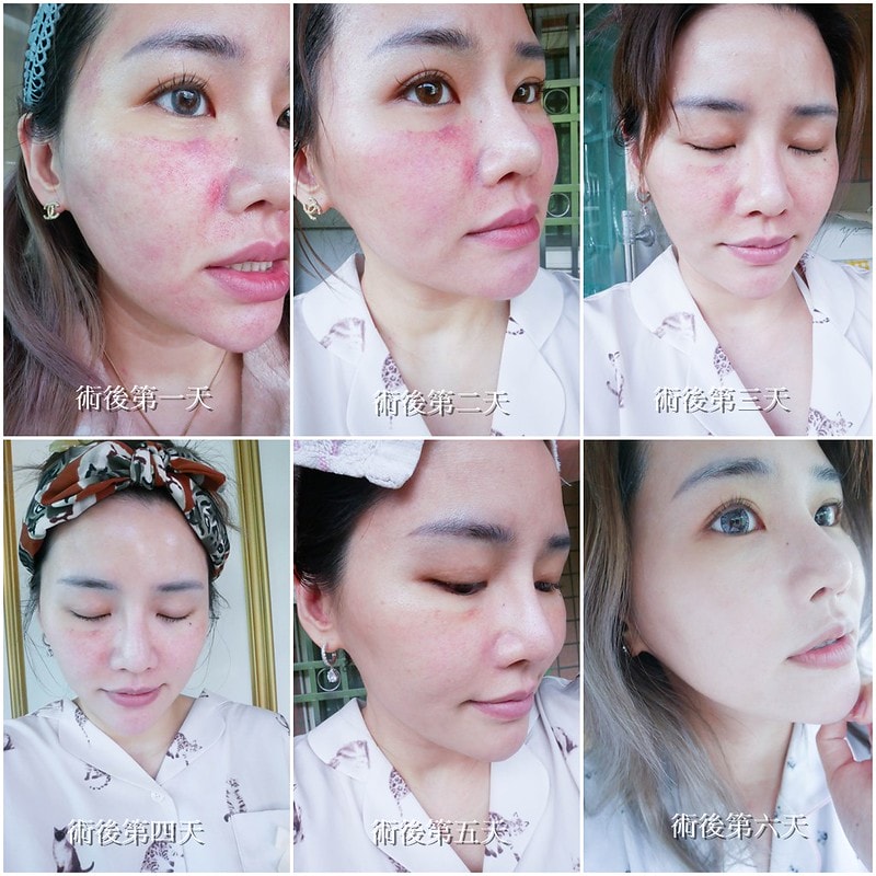 【醫美】Nice Clinic耐斯診所 。水飛梭(海菲秀)+探索皮秒一起來 給我煥然一新晶透好膚質 - 第34張圖 cats