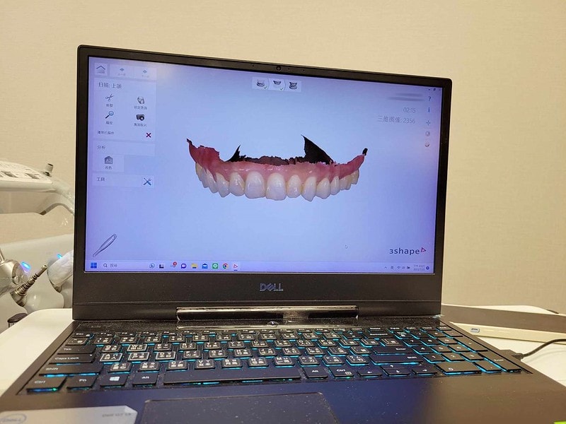 【美白貼片】有關於我的牙齒🦷終於鼓起勇氣做了陶瓷貼片 為什麼要做?注意事項? (板橋蒔美牙醫 薛聖儒醫生) - 第14張圖 434006876_3689097271309453_2305071786208914306_n