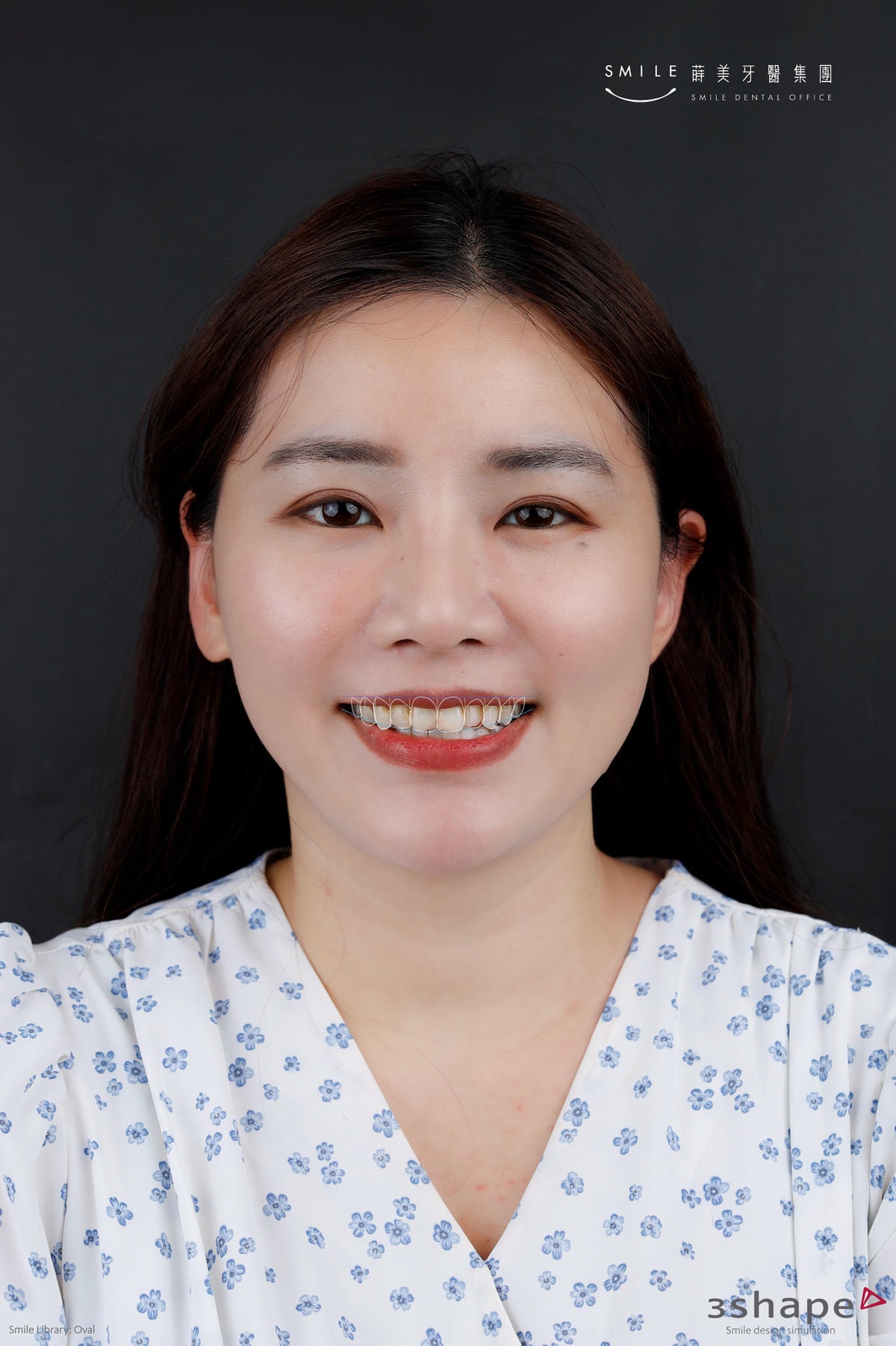 【美白貼片】有關於我的牙齒🦷終於鼓起勇氣做了陶瓷貼片 為什麼要做?注意事項? (板橋蒔美牙醫 薛聖儒醫生) - 第17張圖 親子部落客蘋果-Upper jaw Smile design