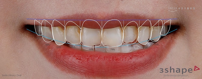 【美白貼片】有關於我的牙齒🦷美白貼片過程記錄 還有更多BA照(板橋蒔美牙醫 薛聖儒醫生) - 第2張圖 蘋果-3shape微笑設計