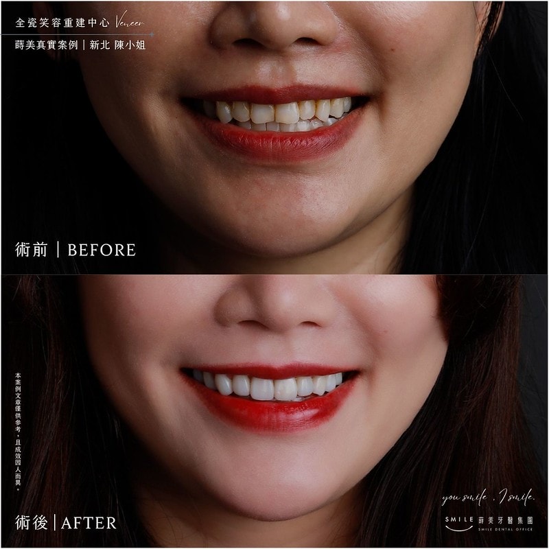 【美白貼片】有關於我的牙齒🦷美白貼片過程記錄 還有更多BA照(板橋蒔美牙醫 薛聖儒醫生) - 第22張圖 北大All-on-4/植牙/全瓷BA版型 - 親子部落客蘋果