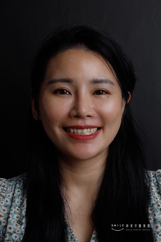 【美白貼片】有關於我的牙齒🦷美白貼片過程記錄 還有更多BA照(板橋蒔美牙醫 薛聖儒醫生) - 第23張圖 親子部落客蘋果-全臉Before