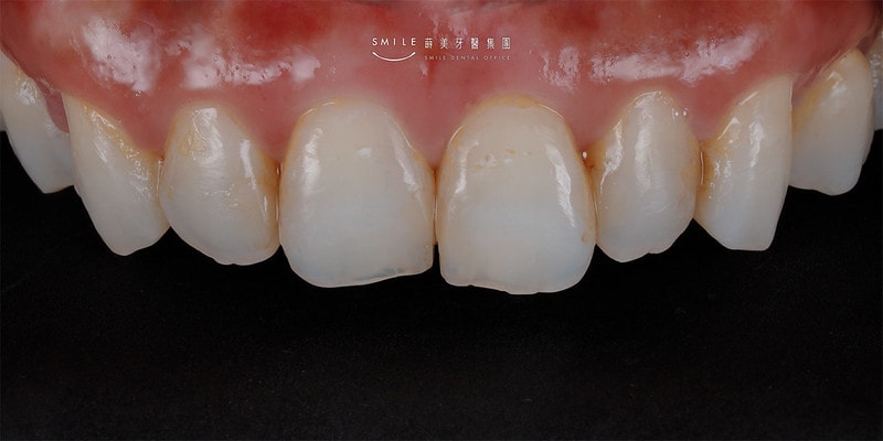 【美白貼片】有關於我的牙齒🦷美白貼片過程記錄 還有更多BA照(板橋蒔美牙醫 薛聖儒醫生) - 第25張圖 親子部落客蘋果-Before1