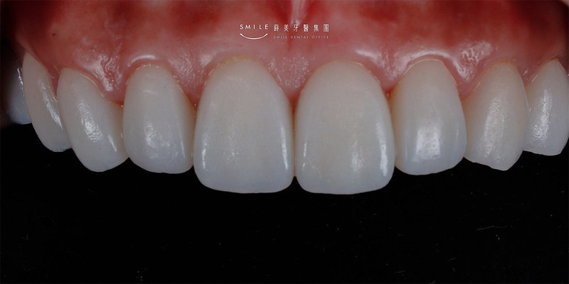 【美白貼片】有關於我的牙齒🦷美白貼片過程記錄 還有更多BA照(板橋蒔美牙醫 薛聖儒醫生) - 第26張圖 親子部落客蘋果-After1